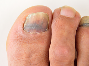 Black nails could mean an injury.